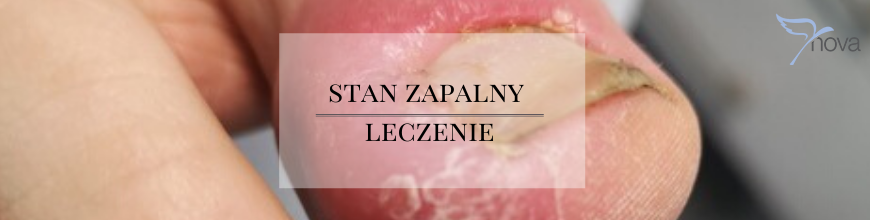 Stan zapalny 