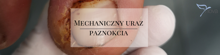 Mechaniczny uraz paznokcia 